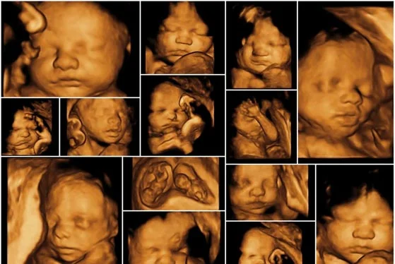 3D/4D pregnancy ultrasound