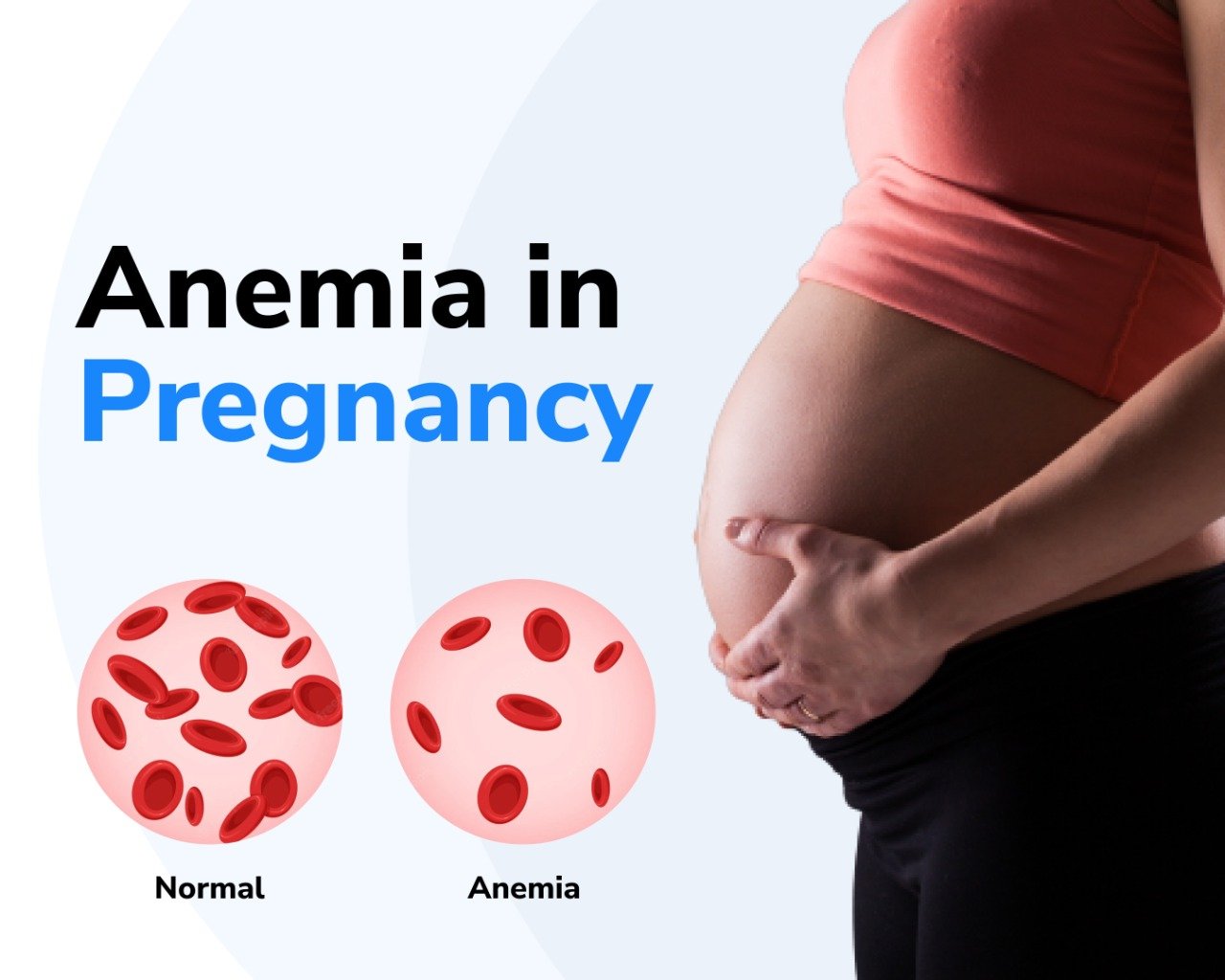 Anaemia in Pregnancy