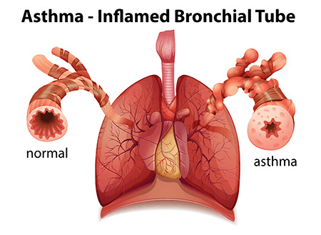 Asthma & respiratory problems