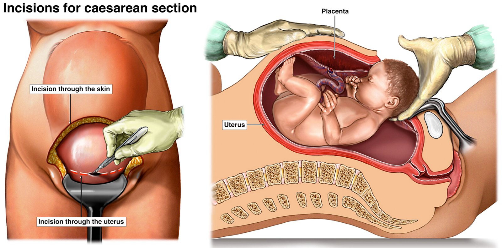 Cesarean delivery