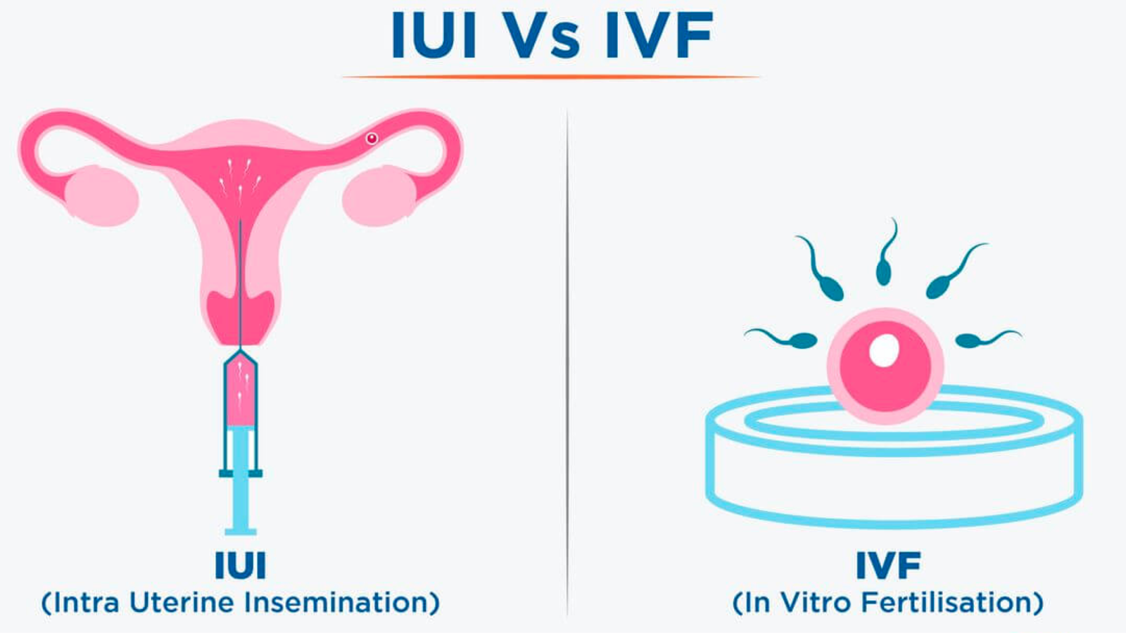 Donor sperm IUI/IVF