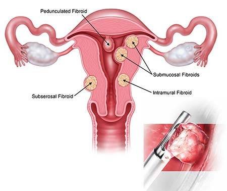 Fibroid removal