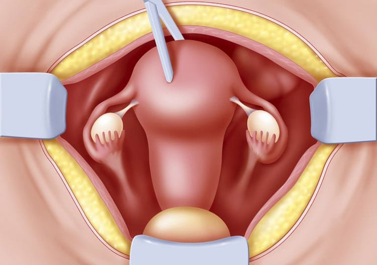 Hysterectomy (uterus removal)