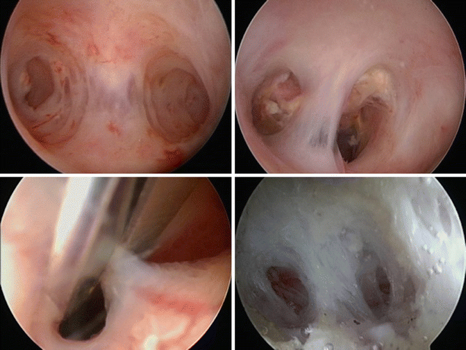 Hysteroscopy (septum, polyp, adhesions)