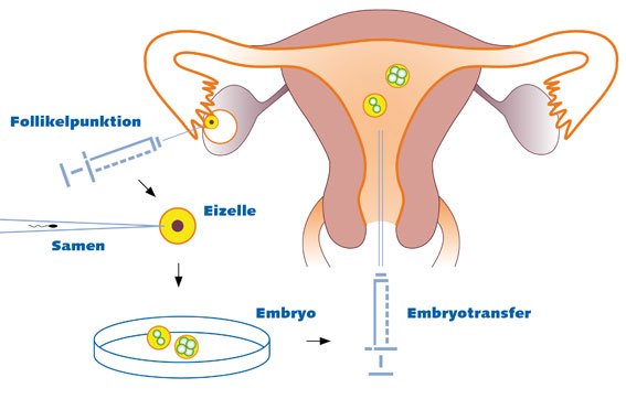 ICSI (Intracytoplasmic Sperm Injection)