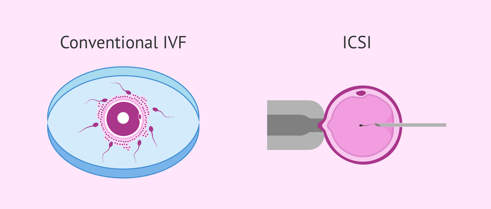 IVF (In-Vitro Fertilization)