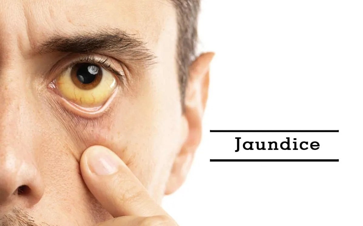 Jaundice diagnosis & treatment