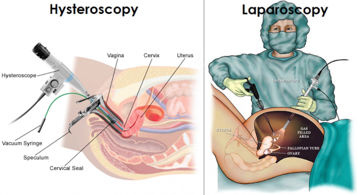 Laparoscopy & Hysteroscopy