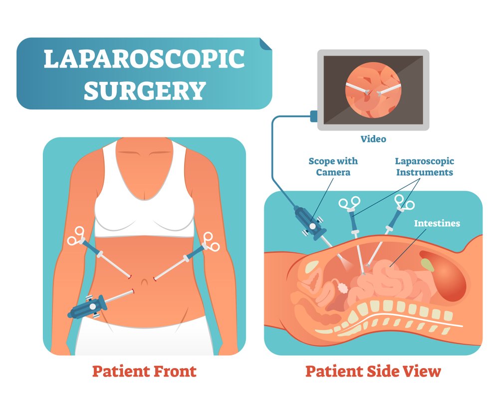 Laparoscopy for fertility