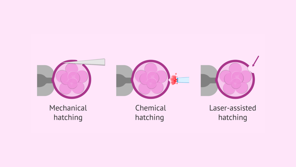 Laser-assisted hatching