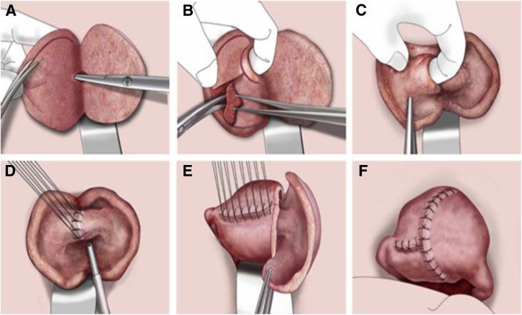 Reproductive Surgeries