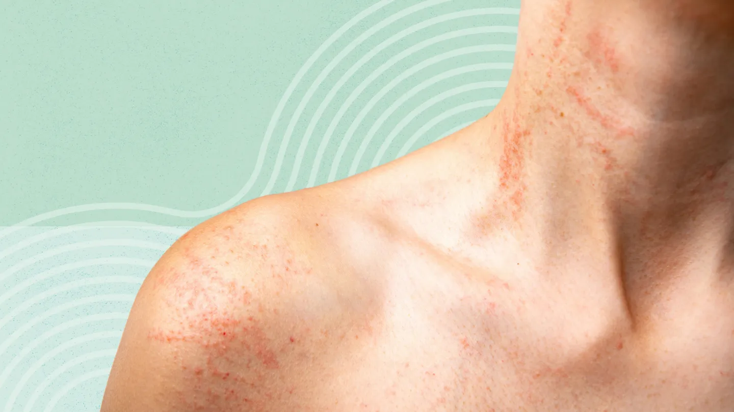 Skin rashes, infections & allergies