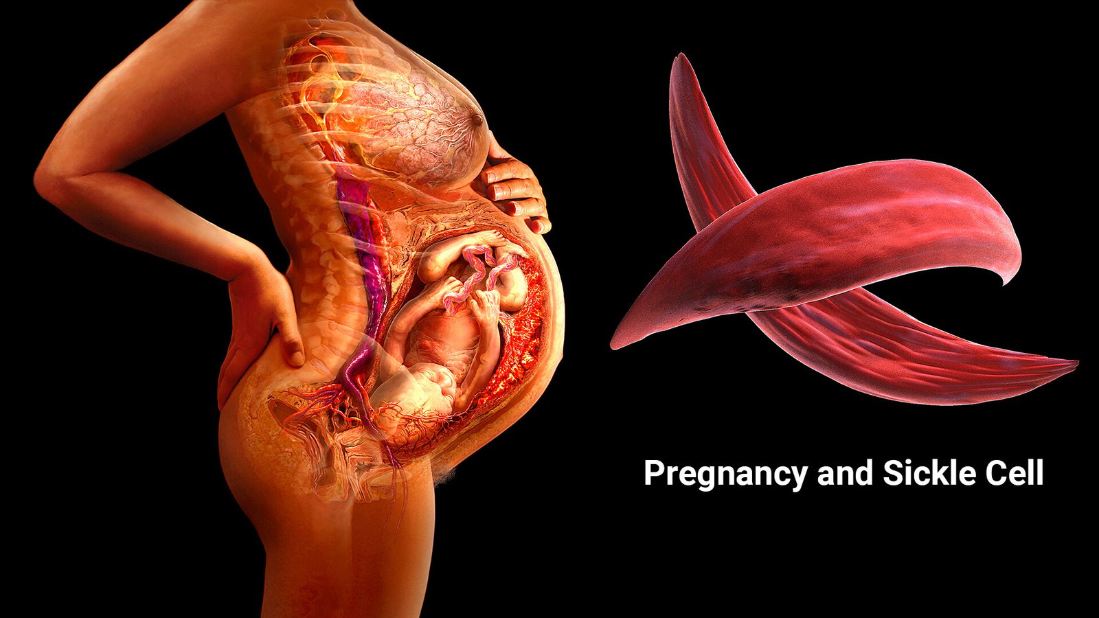 sickle cell pregnancy